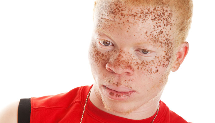 Albinisme chez les humains