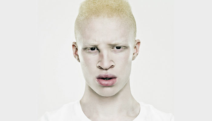 Définition de l'albinisme